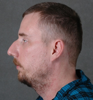 rhinoplasty - patient 5756 - before 4 rhinoplasty - patient 5756 - before 4