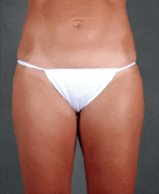 mommy makeover - patient 4452 - after 3 mommy makeover - patient 4452 - after 3