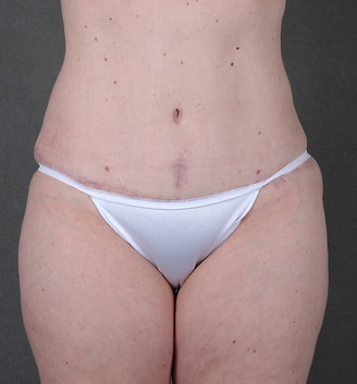 breast lift - patient 5571 - after 7 breast lift - patient 5571 - after 7