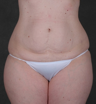 breast lift - patient 5571 - before 7 breast lift - patient 5571 - before 7