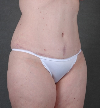 tummy tuck - patient 4832 - after 2 tummy tuck - patient 4832 - after 2