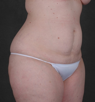 breast lift - patient 5571 - before 6 breast lift - patient 5571 - before 6
