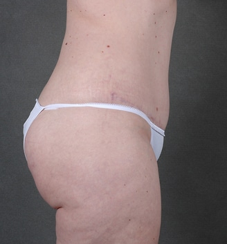 breast lift - patient 5571 - after 5 breast lift - patient 5571 - after 5