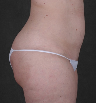 breast lift - patient 5571 - before 5 breast lift - patient 5571 - before 5