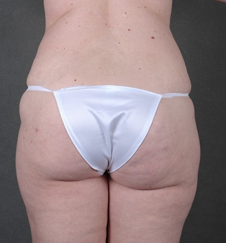 breast lift - patient 5571 - after 4 breast lift - patient 5571 - after 4