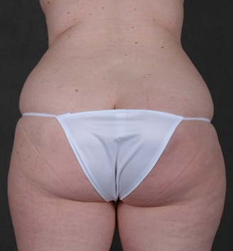 breast lift - patient 5571 - before 4 breast lift - patient 5571 - before 4