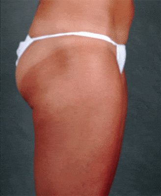 breast augmentation - patient 3939 - after 3 breast augmentation - patient 3939 - after 3