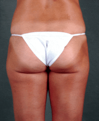 breast augmentation - patient 3939 - after 4 breast augmentation - patient 3939 - after 4