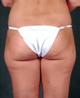 breast augmentation - patient 3939 - before 4 breast augmentation - patient 3939 - before 4