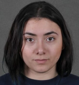 rhinoplasty - patient 5741 - after 1 rhinoplasty - patient 5741 - after 1
