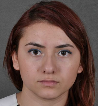 rhinoplasty - patient 5741 - before 1 rhinoplasty - patient 5741 - before 1