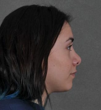 rhinoplasty - patient 5741 - after 3 rhinoplasty - patient 5741 - after 3