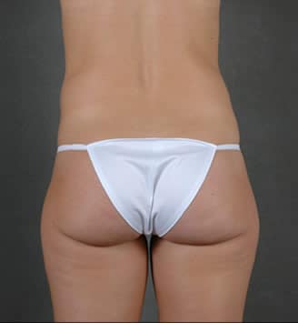 liposuction - patient 3770 - before 7 liposuction - patient 3770 - before 7