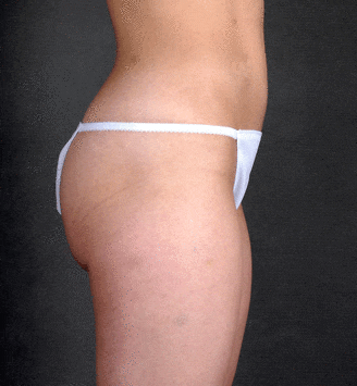 breast augmentation - patient 4743 - before 6 breast augmentation - patient 4743 - before 6