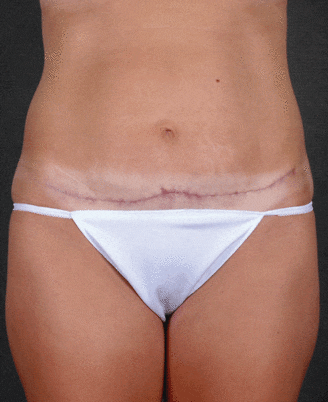 mini tummy tuck - patient 4319 - after 4 mini tummy tuck - patient 4319 - after 4