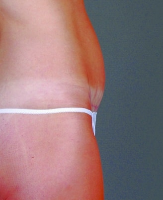 mini tummy tuck - patient 4319 - after 5 mini tummy tuck - patient 4319 - after 5