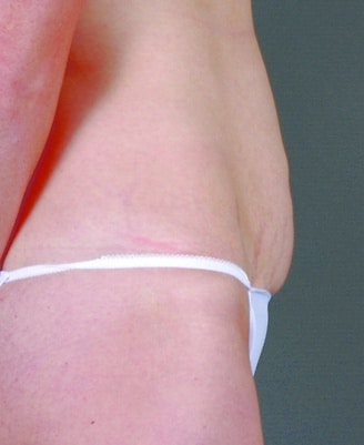 mini tummy tuck - patient 4319 - before 5 mini tummy tuck - patient 4319 - before 5