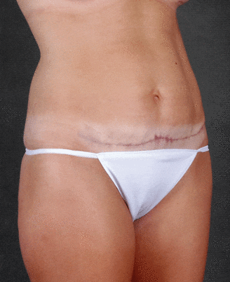mini tummy tuck - patient 4319 - after 6 mini tummy tuck - patient 4319 - after 6