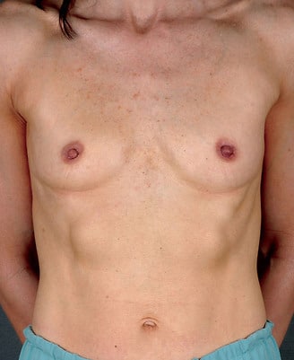 breast augmentation - patient 4140 - before 1 breast augmentation - patient 4140 - before 1