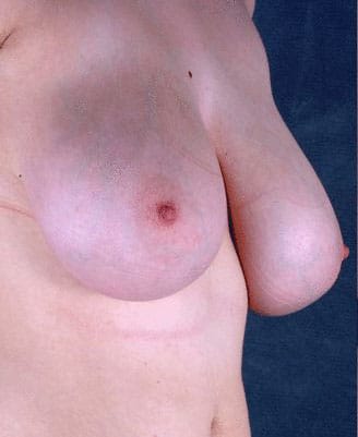 breast reduction - patient 6014 - before 2 breast reduction - patient 6014 - before 2