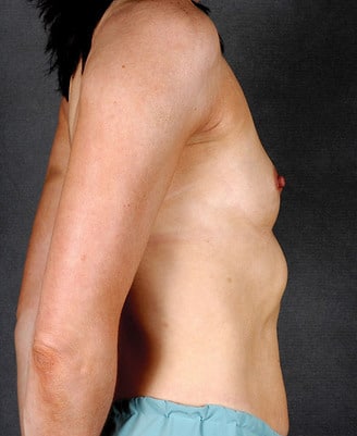 breast augmentation - patient 4140 - before 2 breast augmentation - patient 4140 - before 2