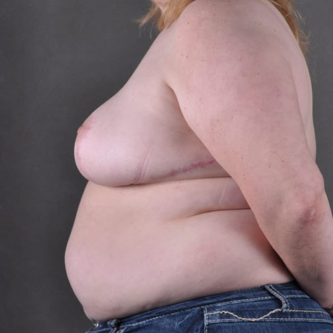 breast reduction - patient 7795 - after 2 breast reduction - patient 7795 - after 2