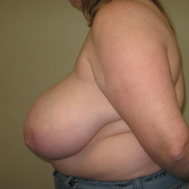 breast reduction - patient 7795 - before 2 breast reduction - patient 7795 - before 2