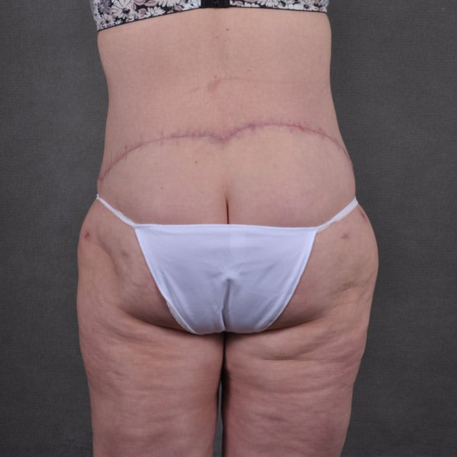 liposuction - patient 7785 - after 4 liposuction - patient 7785 - after 4