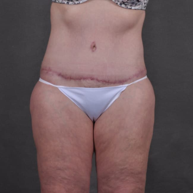 liposuction - patient 7785 - after 1 liposuction - patient 7785 - after 1