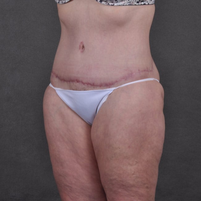 liposuction - patient 7785 - after 3 liposuction - patient 7785 - after 3