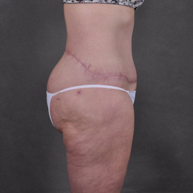 liposuction - patient 7785 - after 2 liposuction - patient 7785 - after 2