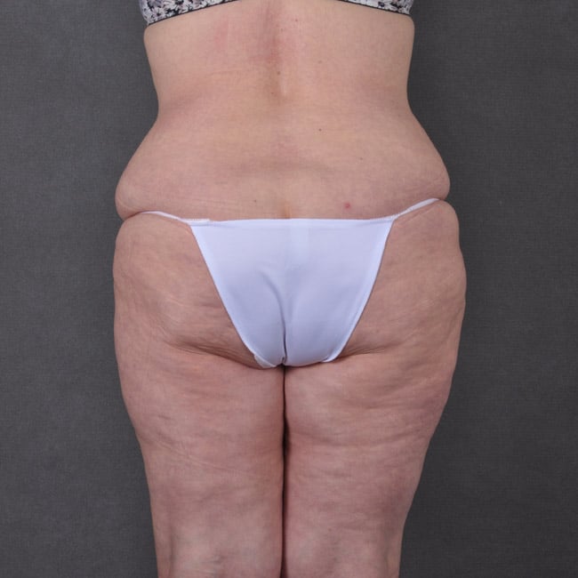 liposuction - patient 7785 - before 4 liposuction - patient 7785 - before 4