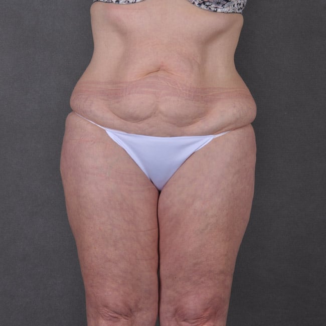 liposuction - patient 7785 - before 1 liposuction - patient 7785 - before 1