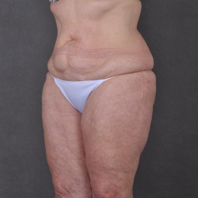 liposuction - patient 7785 - before 3 liposuction - patient 7785 - before 3