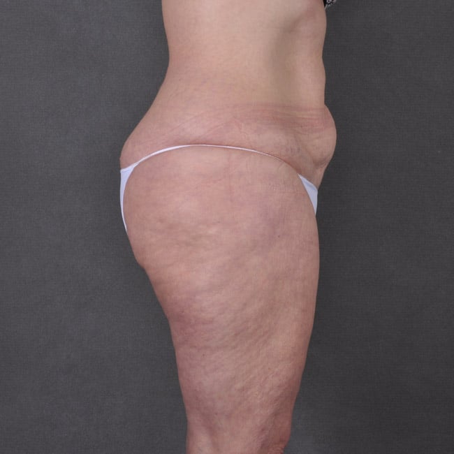 liposuction - patient 7785 - before 2 liposuction - patient 7785 - before 2