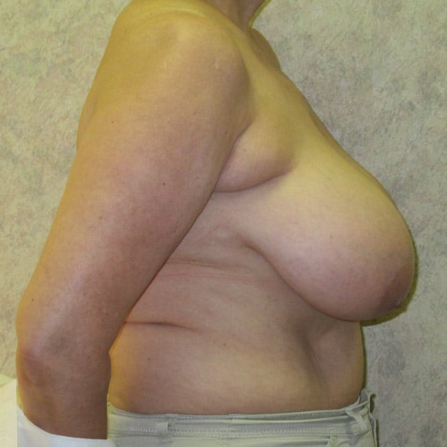 breast reduction - patient 7869 - before 2 breast reduction - patient 7869 - before 2