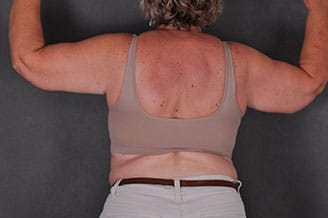 massive weight loss - patient 7820 - after 1 massive weight loss - patient 7820 - after 1