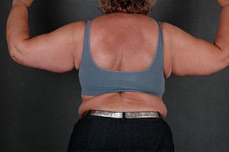massive weight loss - patient 7820 - before 1 massive weight loss - patient 7820 - before 1