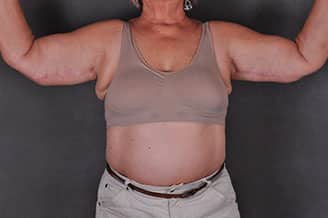 massive weight loss - patient 7820 - after 2 massive weight loss - patient 7820 - after 2