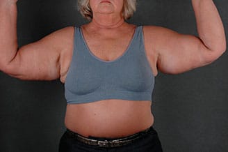 massive weight loss - patient 7820 - before 2 massive weight loss - patient 7820 - before 2