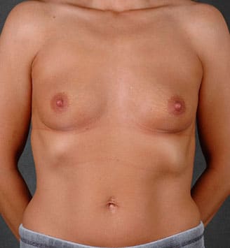 breast augmentation - patient 7862 - before 1 breast augmentation - patient 7862 - before 1