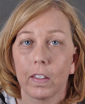 browlift - patient 7931 - after 1 browlift - patient 7931 - after 1