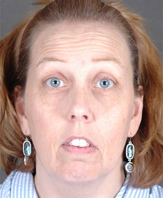 browlift - patient 7931 - before 1 browlift - patient 7931 - before 1