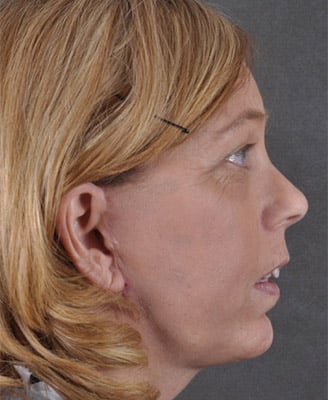browlift - patient 7931 - after 2 browlift - patient 7931 - after 2