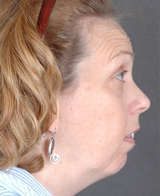 browlift - patient 7931 - before 2 browlift - patient 7931 - before 2
