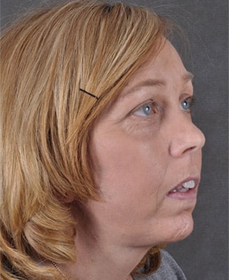 browlift - patient 7931 - after 3 browlift - patient 7931 - after 3