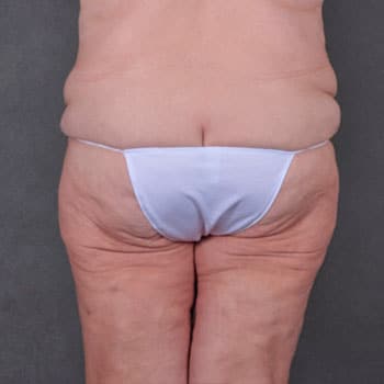 massive weight loss - patient 7939 - before 3 massive weight loss - patient 7939 - before 3