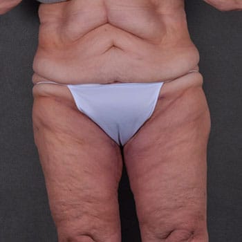 massive weight loss - patient 7939 - after 1 massive weight loss - patient 7939 - after 1