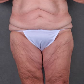 massive weight loss - patient 7939 - before 1 massive weight loss - patient 7939 - before 1