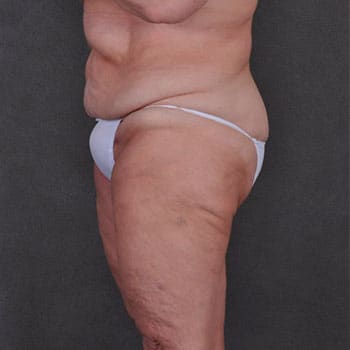 massive weight loss - patient 7939 - after 2 massive weight loss - patient 7939 - after 2